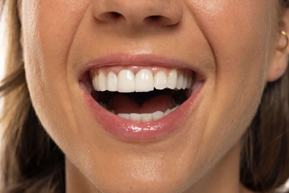 Full-Mouth Rehabilitation North Ogden